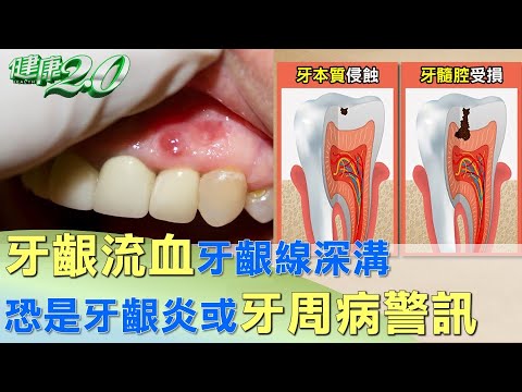 牙齦流血牙齦線深溝 恐是牙齦炎或牙周病警訊 健康2.0 @tvbshealth20