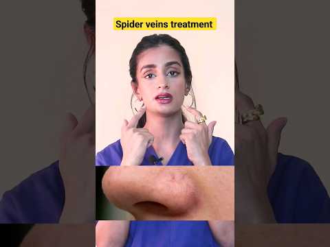 Suffering from spider veins? #laser #sclerotherapy #short