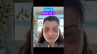 EPIC FACELIFT TRANSFORMATION (Journey)