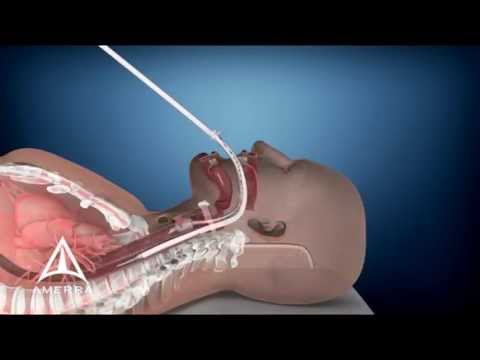 Advanced Cooling Therapy - ECD - Esophageal Cooling Device - 3D Medical Animation