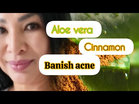 Banish Acne with Aloe Vera & Cinnamon! (DIY Mask Recipe)