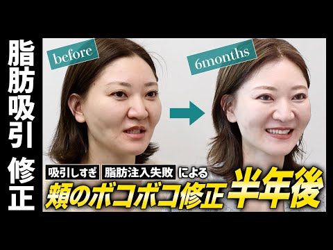 【修正手術】脂肪吸引の修正手術から6ヶ月後。4年前の脂肪吸引で起こった窪み、ボコボコ、脂肪取り残しを改善したい【顔の脂肪吸引】