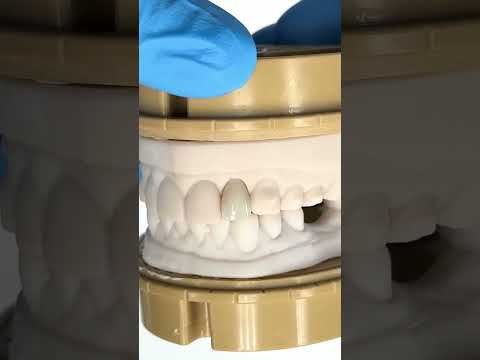 Matching the shade of the adjacent teeth #lsk121shorts #dentist #teeth