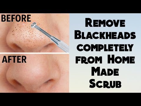 How to remove Blackheads completely from Nose at home | DIY Get rid of Blackheads | Home Remedies