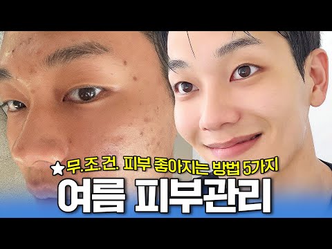 5 skin care tips that will definitely improve your skin🔥 Summer Ver. Acne-prone skin routines.