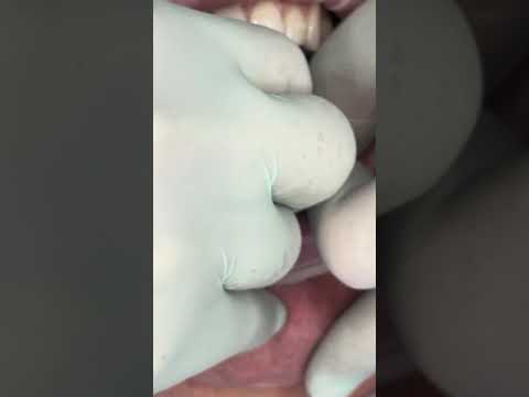 You won't believe how perfectly these anterior implants blend in with this patient's natural teeth