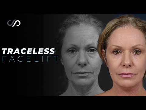 INCREDIBLE Traceless Facelift RESULT! Dr. Stoker and Quinn