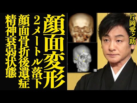 片岡愛之助が舞台落下で顔面変形…緊急手術の絶望的容体に言葉を失う！！２メートルの高さから顔から落下した歌舞伎俳優の顔面複雑骨折、後遺症の真相が…【芸能】