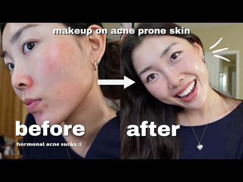 NO FOUNDATION: your skin but BETTER makeup routine for acne prone skin!