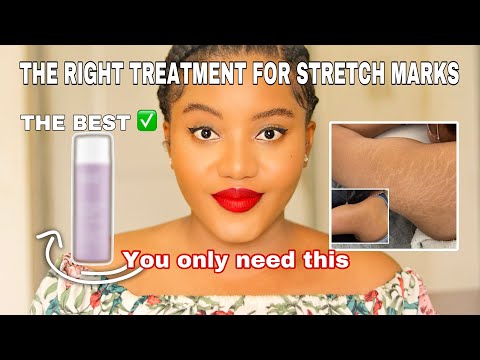 A CURE FOR STRECH MARKS? HOW TO GET RID OF STRECH MARKS | GOODBYE FOREVER