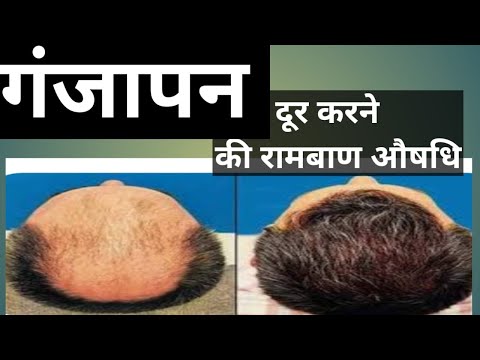 बाल झड़ने से परेशान? तो ये वीडियो आपके लिए ही है | Hair Loss Home Remedy - Aditi's Kitchen