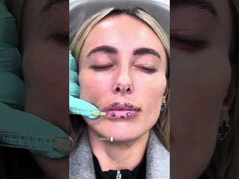 Lip Filler Close-Up: The Instant Results! - DrMedispa