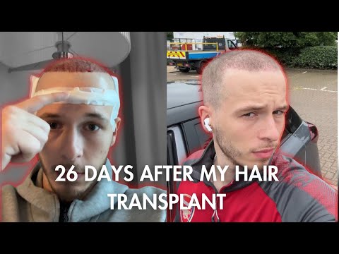 26 days after my hair transplant 👀