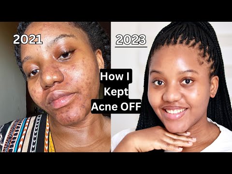 I DID THIS AND GOT RID OF MY ACNE AND HYPERPIGMENTATION | GLASS SKINCARE | CYSTIC ACNE JOURNEY