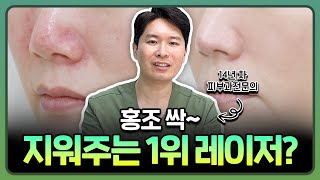 안면홍조 레이저 장단점 비교!(브이빔VS맥스지)