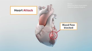 The differences between heart attack and cardiac arrest