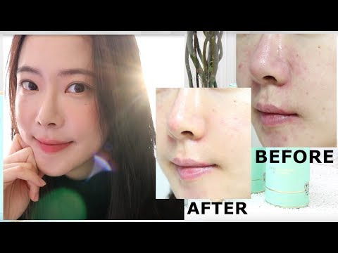 피부 회복이 중요한 이유! 여드름 없애고 안 나게 하는 방법 Acne Skincare / 짱세 ZZANGSE