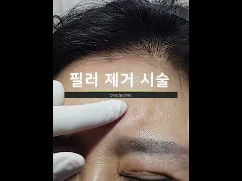 Filler Removal with needle punch  (필러 제거 시술) #shorts