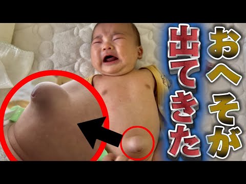 【でべそ】赤ちゃんの１割がなる病気！？臍ヘルニア