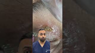 xanthelasma removal | Dr. Somji