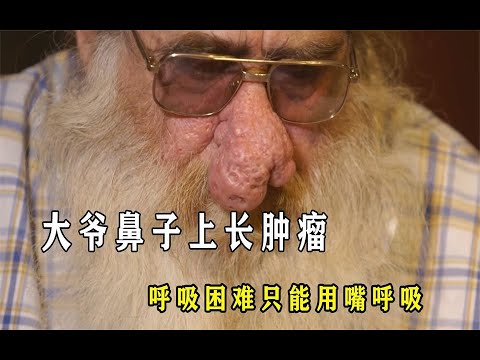 大爷鼻子长超大肿瘤，没办法用鼻子呼吸，晚上饱受折磨没法睡觉