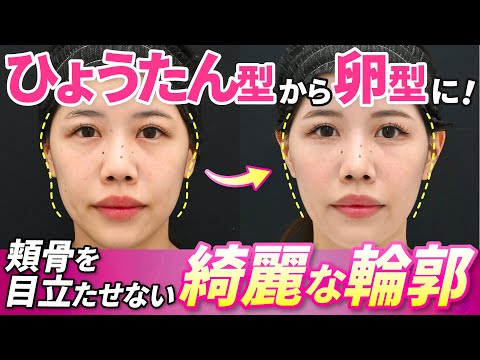 【輪郭手術密着】ひょうたん型から卵型に！口元のもたつきと頬痩けを解消。スタッフさんの輪郭手術に密着【脂肪吸引 × 脂肪注入 × 糸リフト】