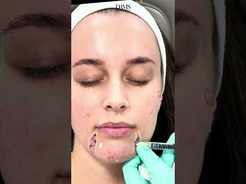 Instant Glow-Up: Educational Dermal Filler Transformation | Doctor's Precision