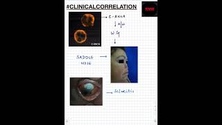 #Shorts|ClinicalCorrelation| NEET/NEXTPG/FMGE/MBBS | Wegener's Granulomatosis