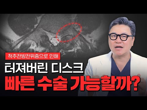 척추전방전위증으로 인해 터진 디스크, 빠른 수술 가능 할까? | 척추 MRI 소견 | 참포도나무병원 이동엽 원장