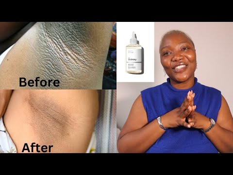 HOW TO GET RID OF DARK UNDERARM | Does glycolic acid work? #darkunderarm #glycolicacid