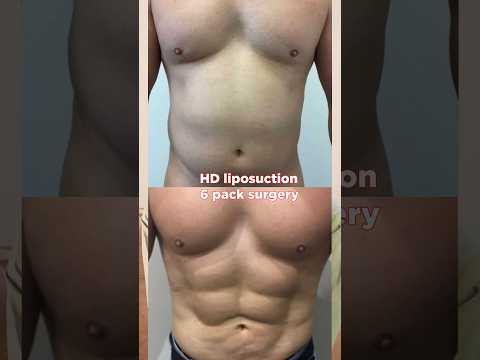 Achieve a defined 6 pack without exercise! #plasticsurgery #sculpted #hdliposuction #6packs