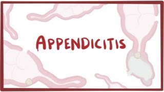 Appendicitis - causes, symptoms, diagnosis, treatment & pathology