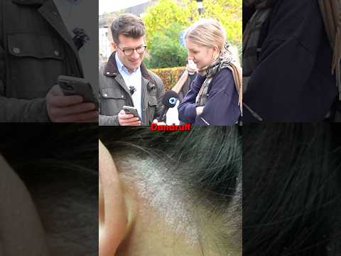 Do members of the public recognise scalp psoriasis? #shorts