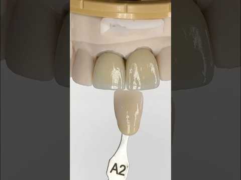 Metal Ceramic Incisors #lsk121shorts #dentist #teeth