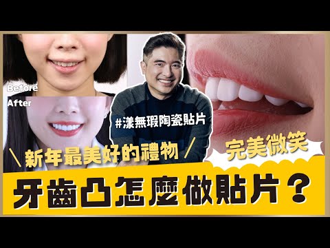 牙齒凸怎麼做陶瓷貼片？不矯正直接做貼片會暴牙？嘴凸？｜#漾無瑕貼片 #陶瓷貼片 #貼片 #美白貼片 #隱適美矯正【祐民牙醫－隱適美旗艦店】鑽石級楊大為醫師