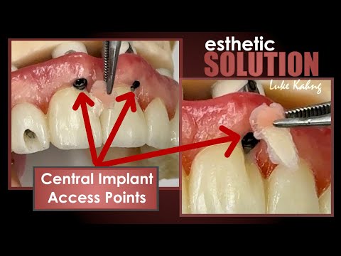 Highly Esthetic Solutions for Difficult Case with Front, Central Implant Access Points