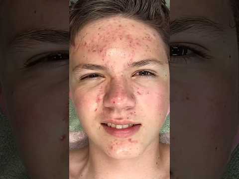 180 Skin Transformation 🌀 Set your reminders⏱️ #180transformation #acne⁠