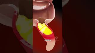 How Appendicitis Happens | appendix symptoms #shorts - creativelearning3d