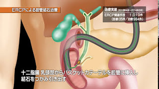 【すい臓がん】医療法人渓仁会　手稲渓仁会病院 消化器内科　胆・膵グループ