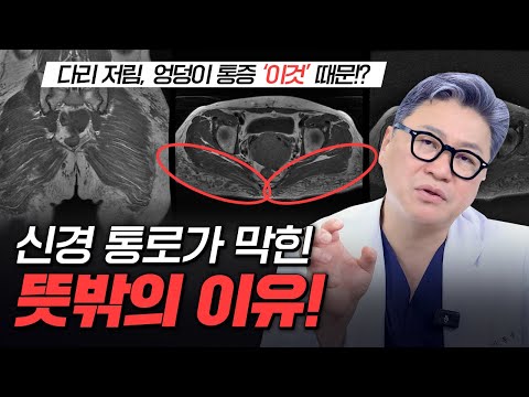 신경 통로가 막힌 뜻밖의 이유! 척추 MRI 소견 | 참포도나무병원 이동엽 원장