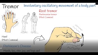 Tremor - Shaking hands (hand tremors) Causes and treatment.  Parkinson or Physiological Tremor?