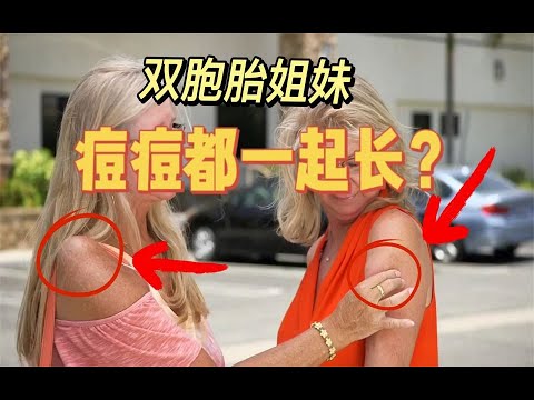 双胞胎姐妹竟然连痘痘都一起长？