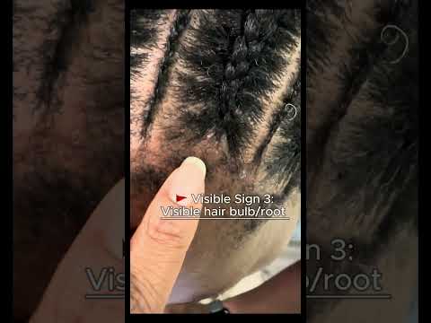 6 Signs your braids could lead to traction alopecia