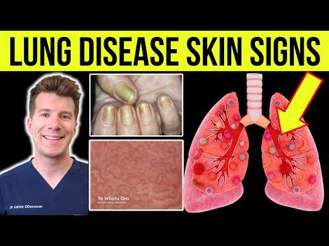 SKIN and NAIL SIGNS associated with LUNG DISEASE