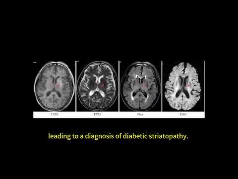 Chorea in hemodialysis patients – Video abstract [490816]