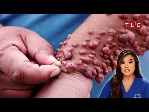 Bumps That Have Stayed Since Age 13! | Dr Pimple Popper TLC