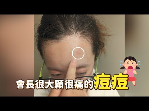 火氣大讓你冒痘了？！阿淇博士 靠Dr.May「B3抗痘精華」撫平火爆痘！