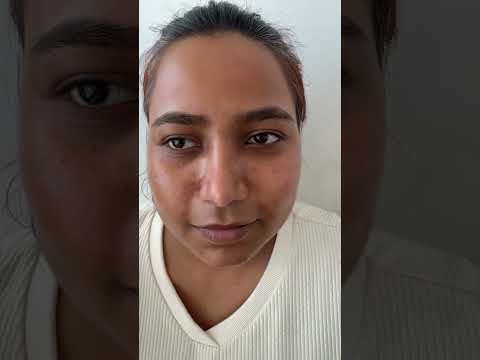 Rhinoplasty with Broad Nose Surgery - Before & After