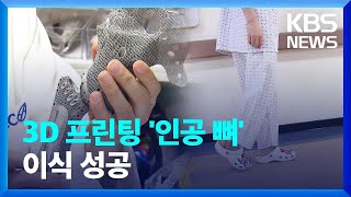 3D프린팅 인공 뼈 수술…“이젠 걸을 수 있어요” / KBS  2023.01.19.