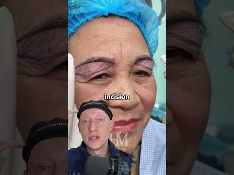 Unconventional Blepharoplasty | Plastic Surgeon Reacts